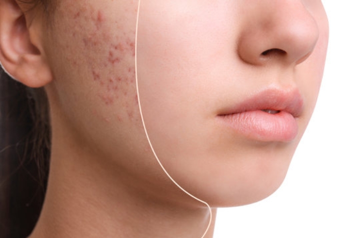 Acne Treatment--------30